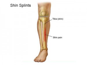 shin-splints