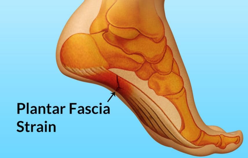 running inserts for plantar fasciitis