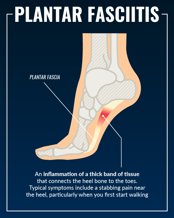 Does Plantar Fasciitis Cause Knee Pain?