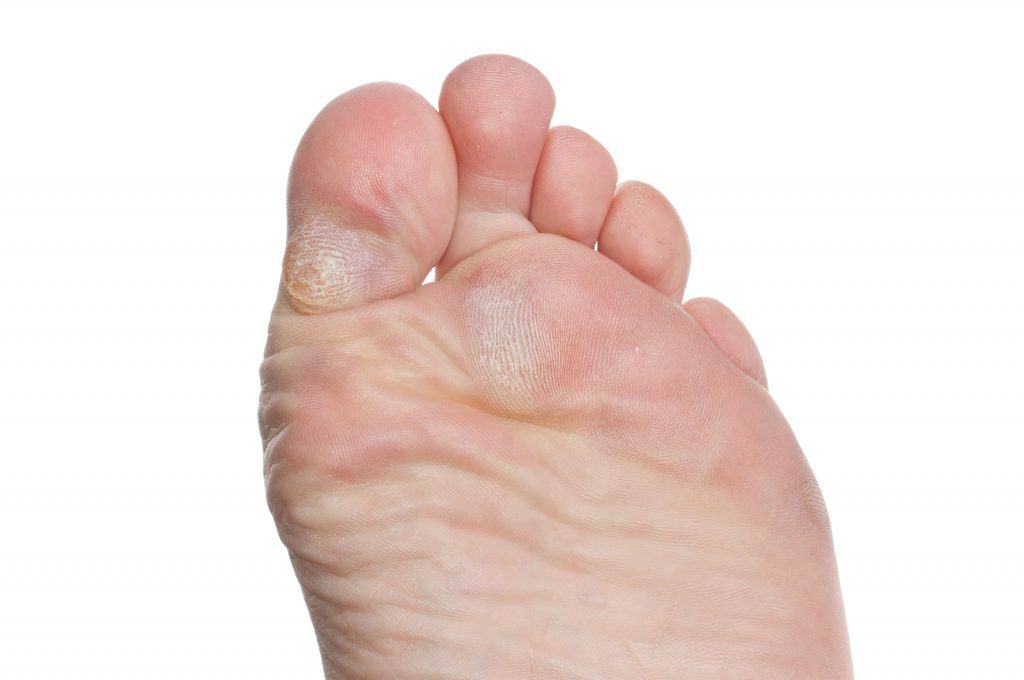 blister under callus