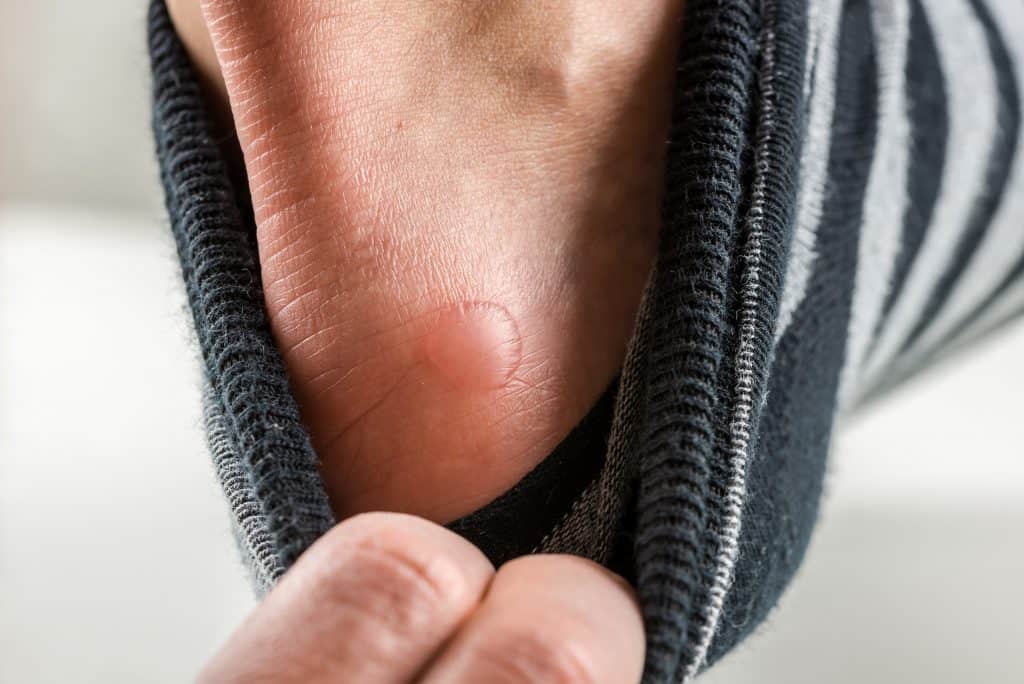 blister under callus