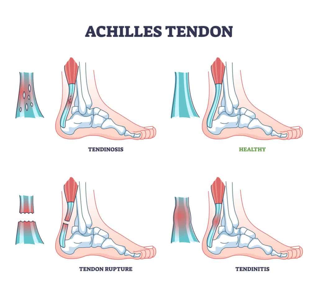 Why Does My Achilles Hurt When I Run: 5 Reasons: achilles tendonitis