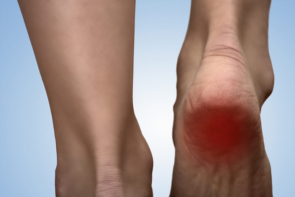 Painful heel with red spot on woman's foot.